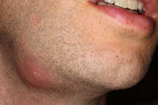 Снимка на абсцес на брадичката на човек