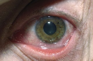Очната инфекция на херпес симплекс може да доведе до зачервяване и подуване на окото