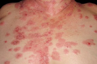 Много болезнени, червени петна с малки мехури се разпространяват върху бяла кожа, разпръснати по гърдите на жената