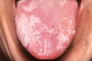 Розов език, който излиза от устата с плътни бели петна от лявата страна и върха