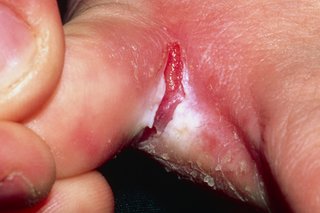 Напукана кожа между пръстите, причинена от крака на спортиста
