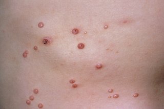 Обрив на Molluscum contagiosum