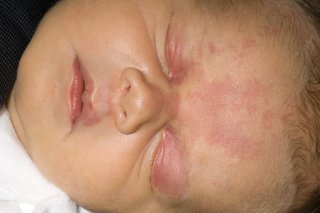 Изображение на бебешкото лице със сьомга на петна по клепачите и челото