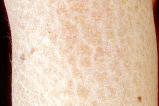 Близък план на ръката или крака на човек, показващ сухата, люспеста кожа на ихтиоза.