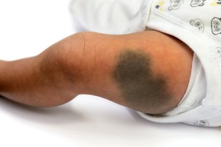 Изображение на крак на азиатско бебе с голям роден белег в тъмен цвят, който прилича на синина