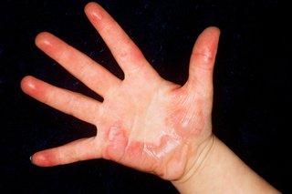 Снимка на изгаряне на ръката