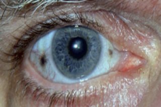 Око, засегнато от алкаптонурия, с две кафяви петна по бялото на окото