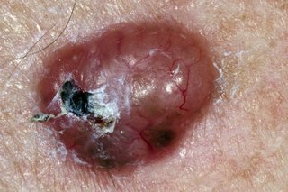 Снимка на немеланомния рак на кожата