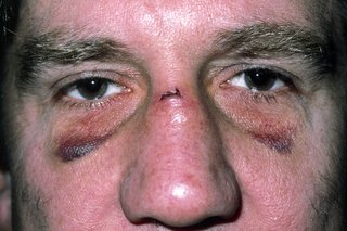 Мъж с две черни очи и порез на носа