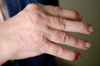 Едър план на ръката на човек, показващ артрит в ставите на пръстите