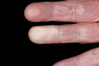 Бели пръсти, причинени от Рейно