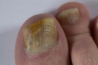 Гъбична инфекция на ноктите, която се разпространява в цял нокът на крака.