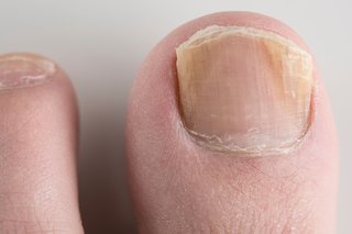 Гъбична инфекция на ноктите на ръба на нокътя на крака.