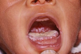 Бяло покритие на езика на детето