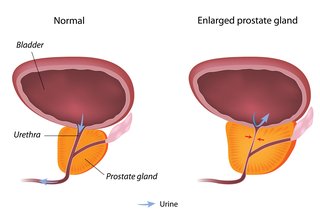 Диаграма на нормална простата и увеличена простата.