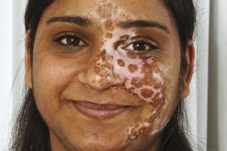 Снимка на жена със сегментно витилиго, засягащо лицето