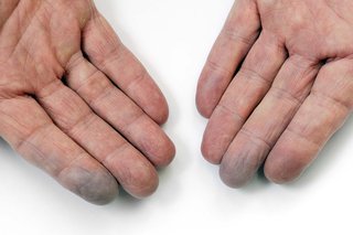 Сини пръсти, причинени от Рейно