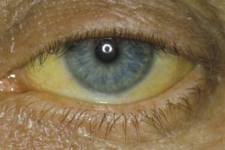 Снимка, показваща жълти бели очи