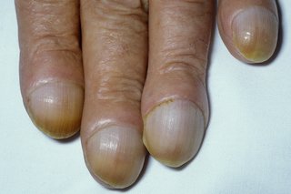 Нокти на нокти, които се извиват над заоблени върхове на пръстите