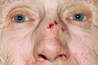 Възрастна дама с порязване на носа и кървене от носа