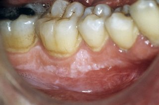 Слаб бял петно върху венците, точно под зъбите