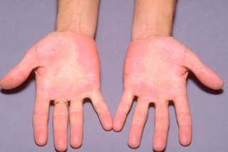 Червени петна по ръцете, причинени от еритромелалгия.