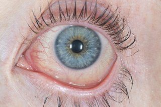 Червено и сълзящо око, причинено от конюнктивит