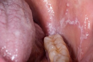 Отворена уста, показваща долния ред зъби, с бели петна по езика и вътре в бузата