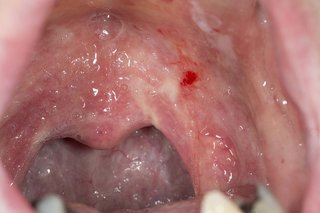 Червени петна в устата, причинени от орална млечница