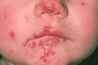 Малко дете с рани от импетиго и мехури по лицето