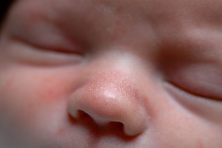 Бели петна по носа на бебето