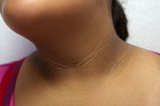 Acanthosis nigricans на шията