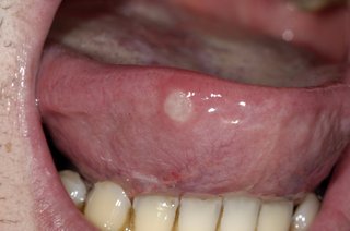 Бяла / сива кръгла рана отстрани на език, който се измъква от устата