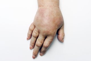 Разтегната кожа на ръката и ръката, причинена от оток