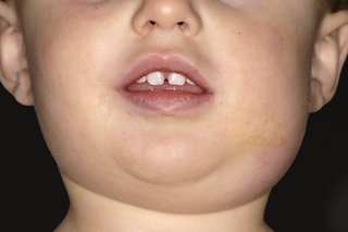 Дете с подуто лице, причинено от паротит.