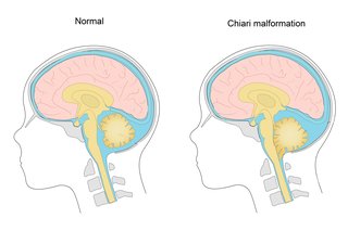 Диаграма, показваща малформация на Chiari