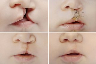 Снимки на цепнатина на устните преди и след операцията