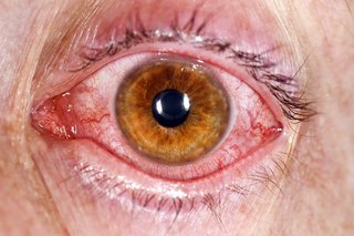 Червено и пясъчно око, причинено от конюнктивит