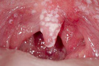 Бели петна в устата, причинени от орална млечница