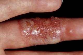 Мехури по пръста, причинени от херпесен вирус