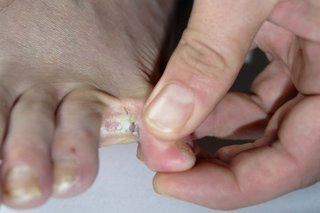 Бяло петно между пръстите, причинено от крака на спортиста