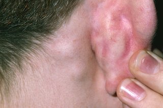 2 малки бучки под кожата зад дясното ухо на някого