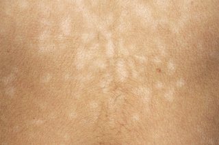 Тъмна кожа с по-малки светли петна, причинени от питириазис версиколор.